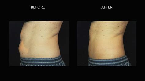 COOLSCULPTING ® FAT REDUCTION IN ST. LOUIS, MISSOURI.
